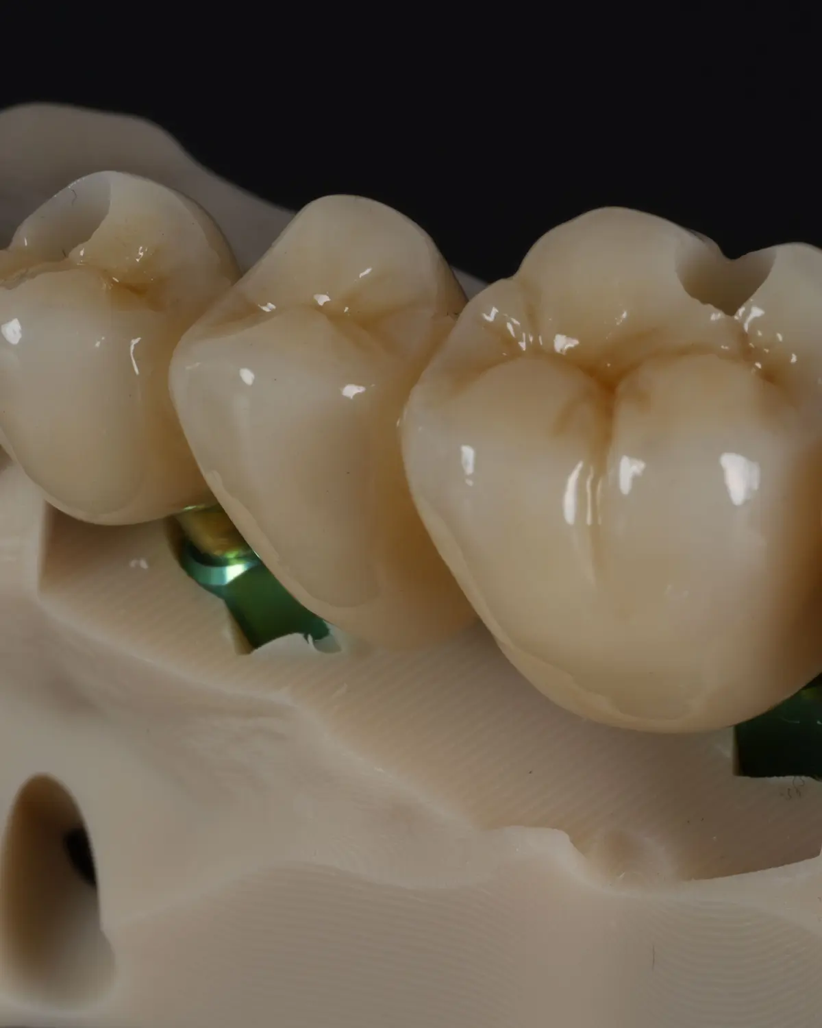 A three-unit implant bridge seated on its model