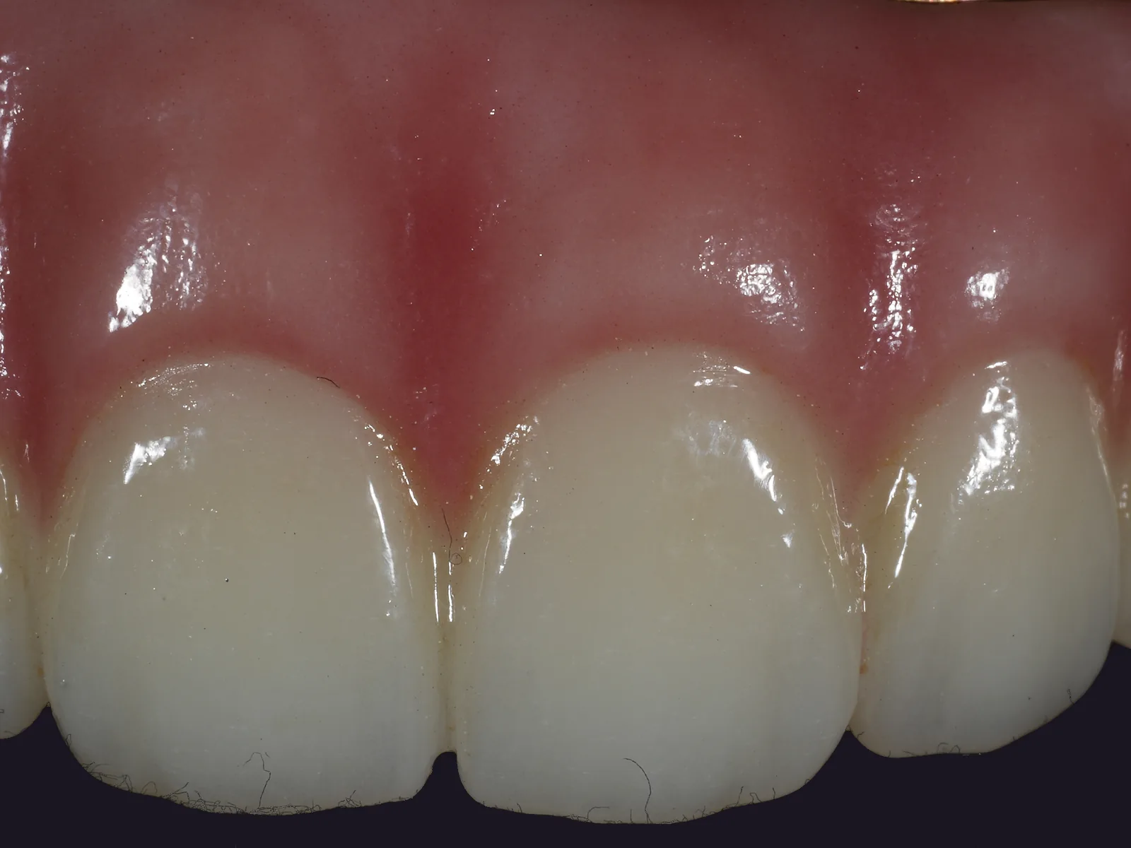 Close up of the front teeth of a full-arch bridge, the gum deeper between the teeth and lighter over each root