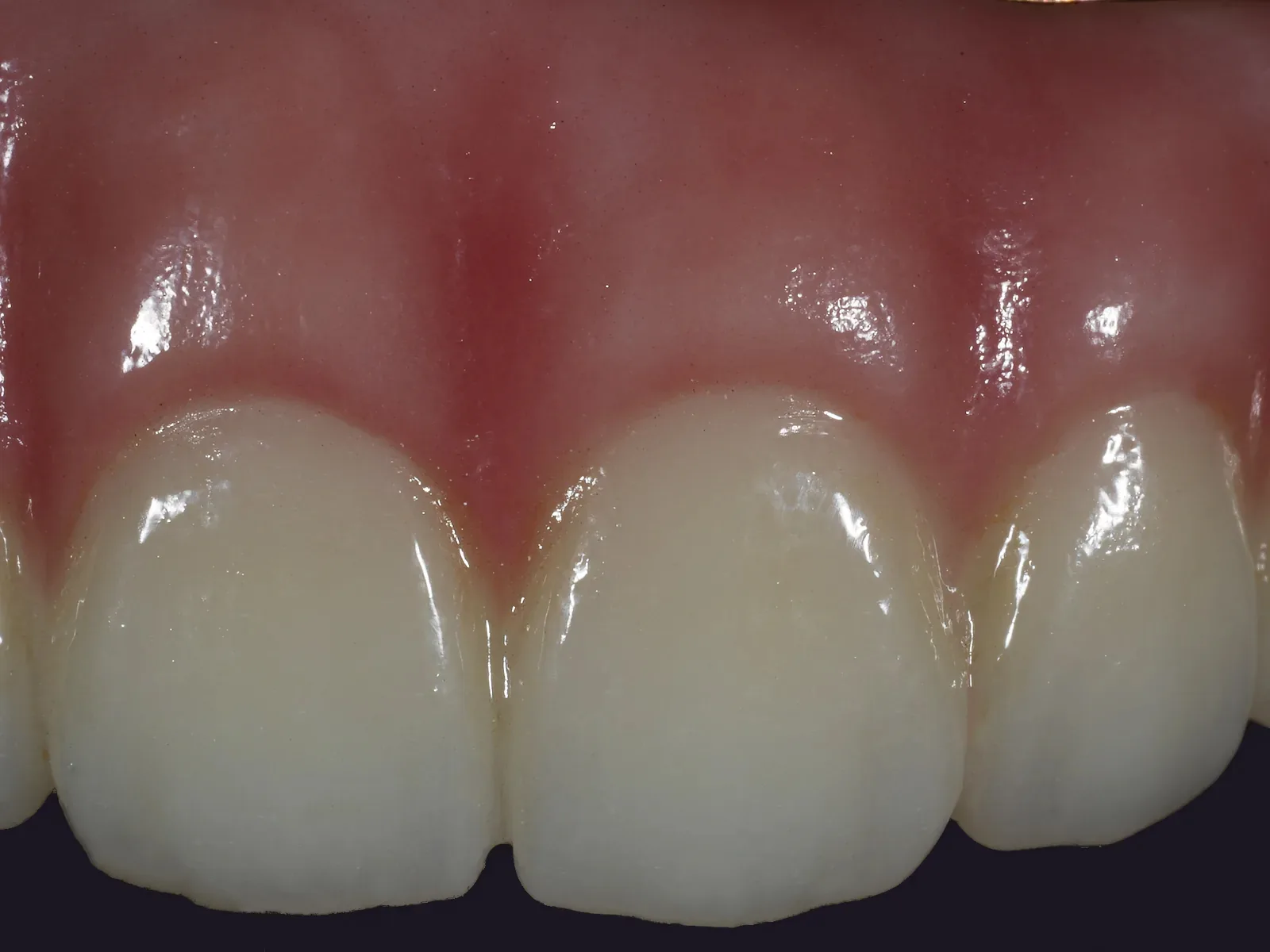 Close up of the front teeth of a full-arch bridge, the gum deeper between the teeth and lighter over each root