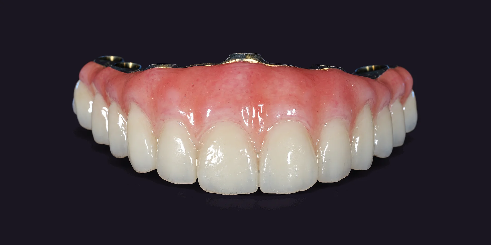 A finished upper full-arch bridge from the front, zirconia teeth on hand-shaded gum