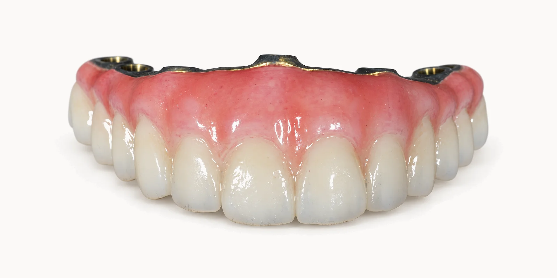 A finished upper full-arch bridge from the front, zirconia teeth on hand-shaded gum