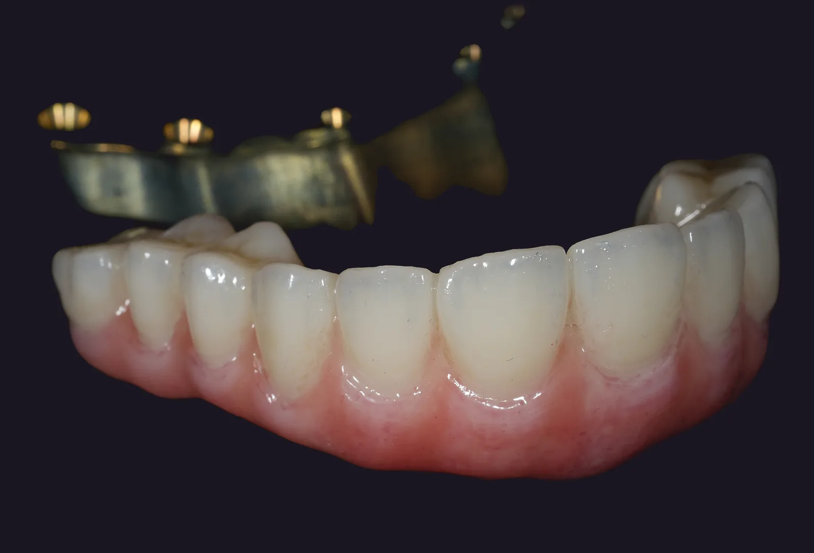 A gold-anodized titanium framework held above the zirconia arch it carries