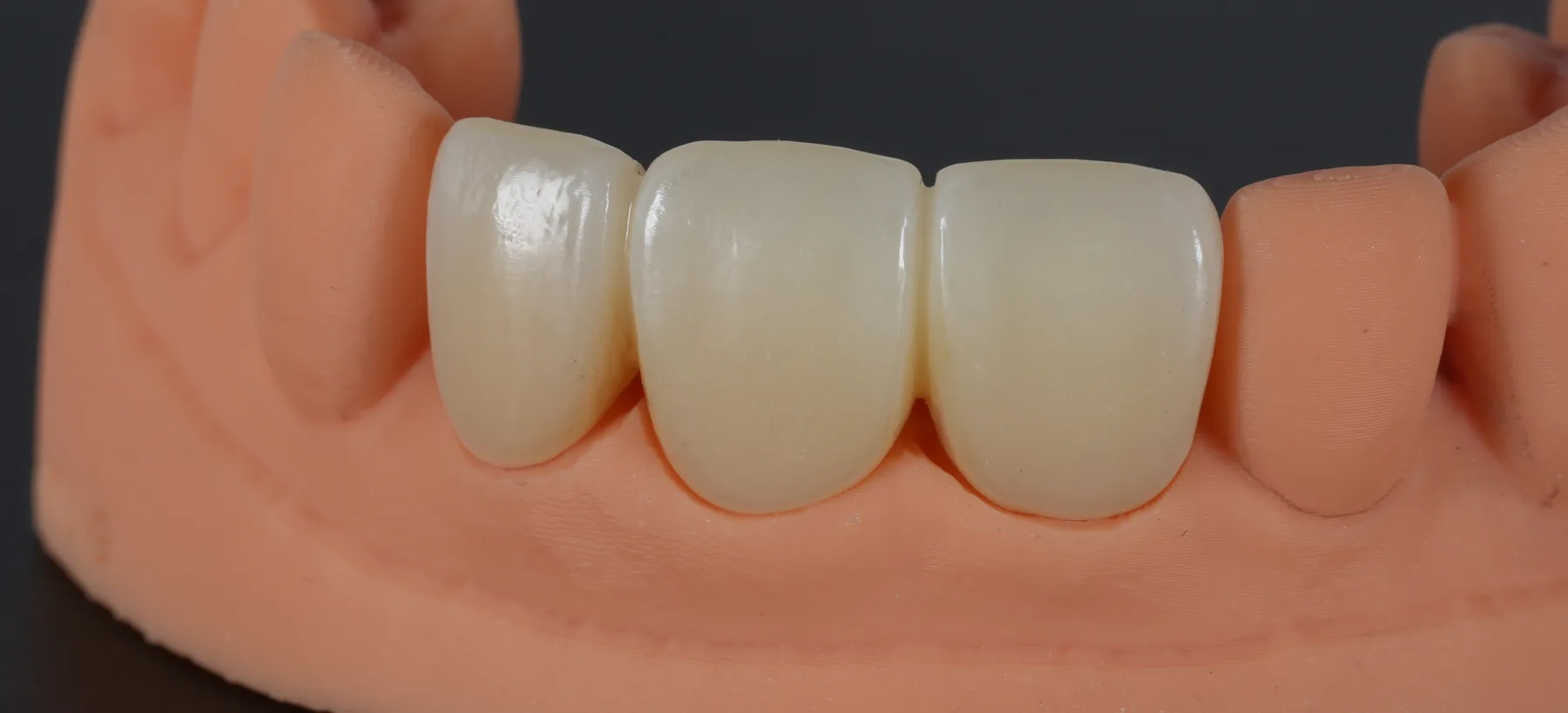 A three-unit anterior bridge seated on its printed model, on a black ground