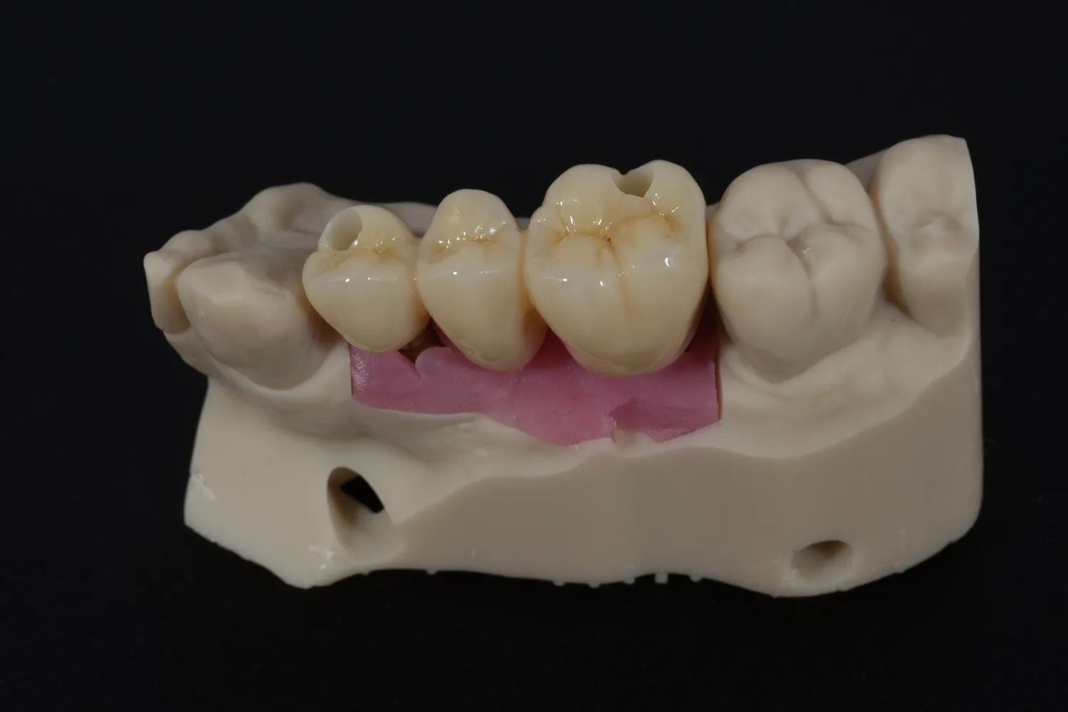 A three-unit posterior bridge seated on its printed model, the pontic site marked in pink