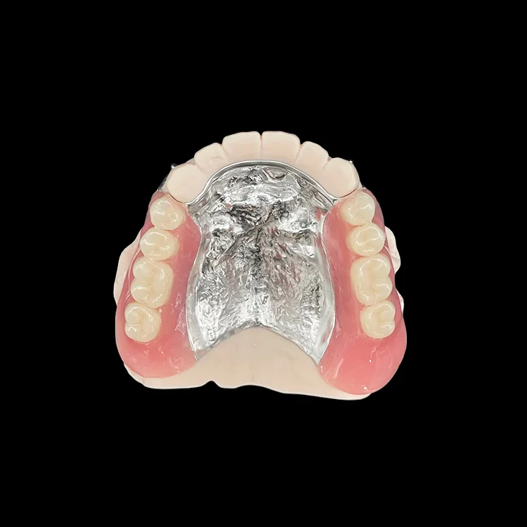 A partial denture with a cast metal framework, seen from the palate