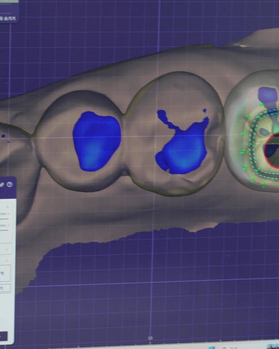 A crown design in CAD with its contact areas shown in blue