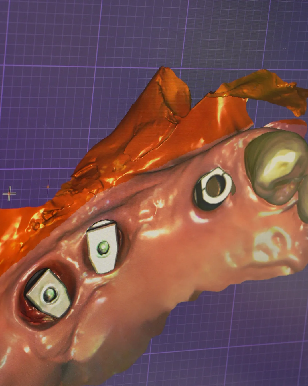 An implant scan open in CAD, the scan bodies standing in the gum