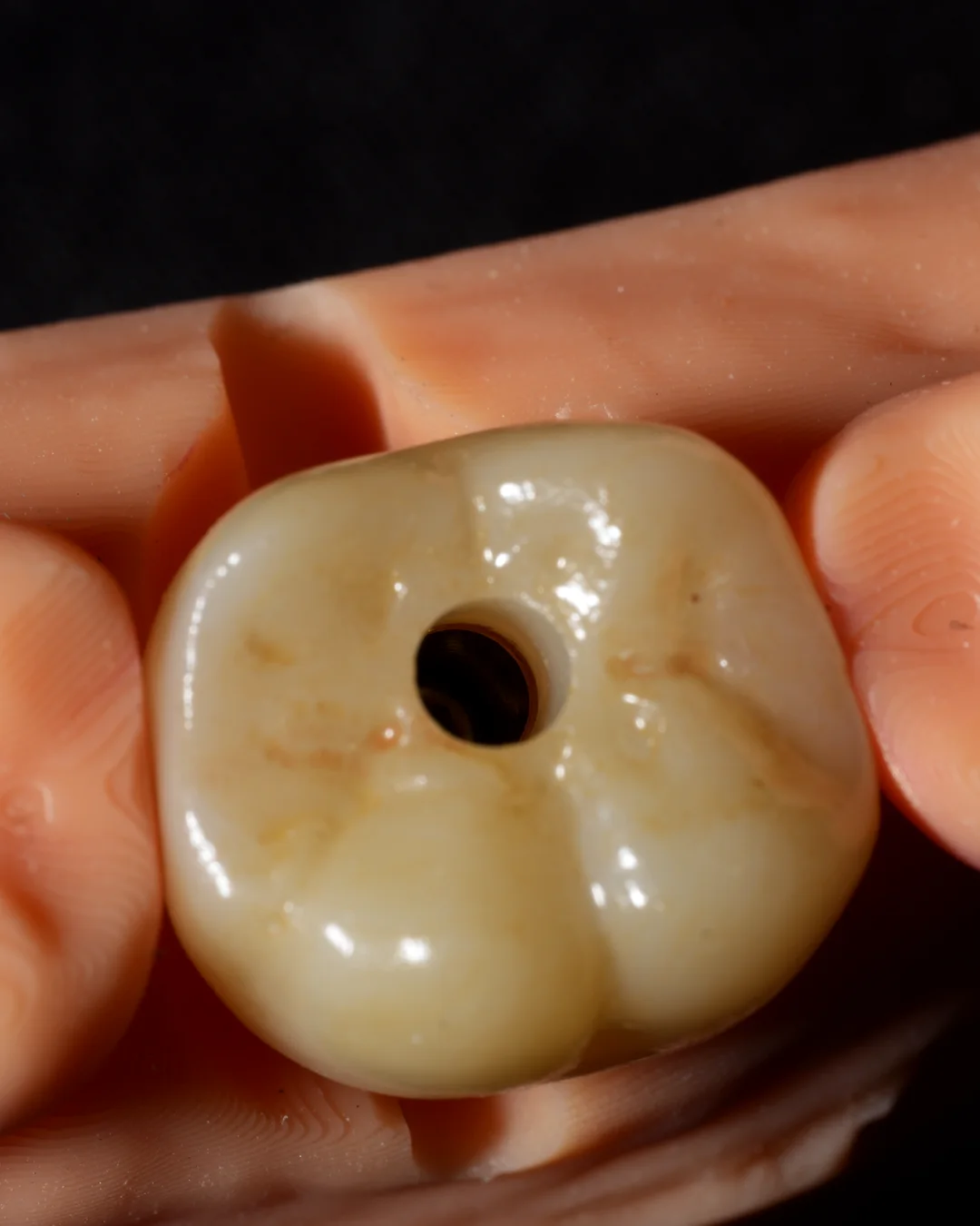 A screw-retained implant crown seated on the model, its access hole in the centre