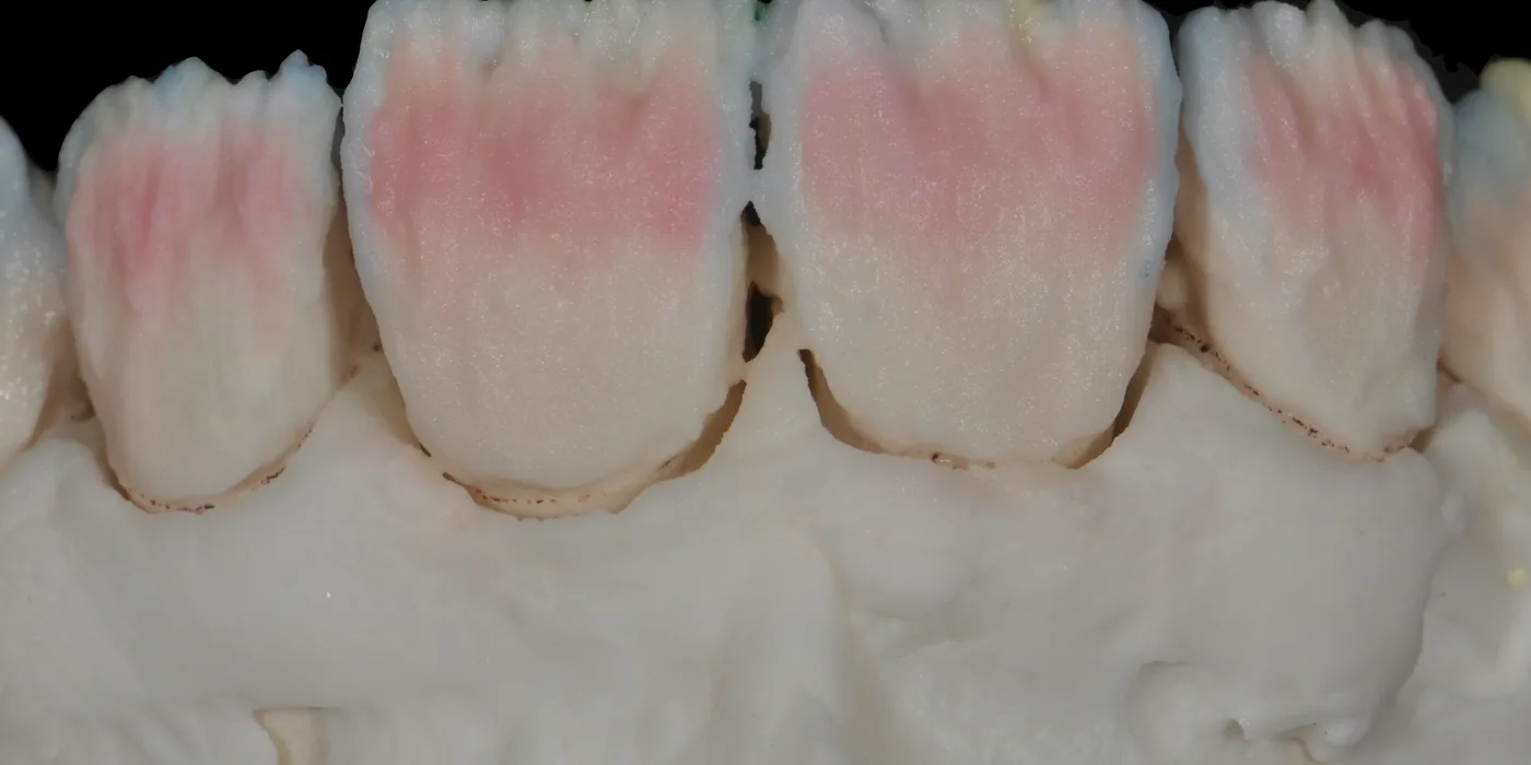 Six crowns mid-build on the model, pink dentin and mamelons visible under the first enamel layer