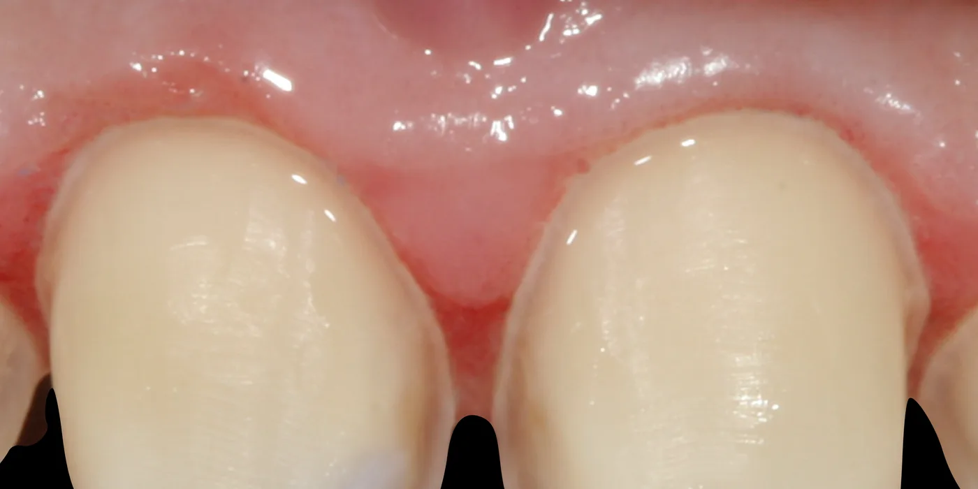 Six prepared anterior teeth, seen from the front
