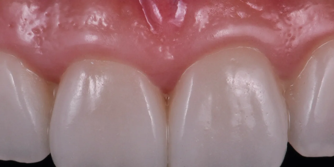 The six finished crowns seated in the mouth