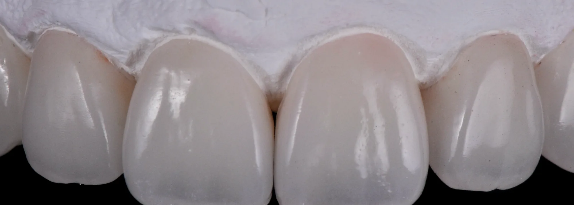 Six layered anterior crowns seated on their model, on a black ground