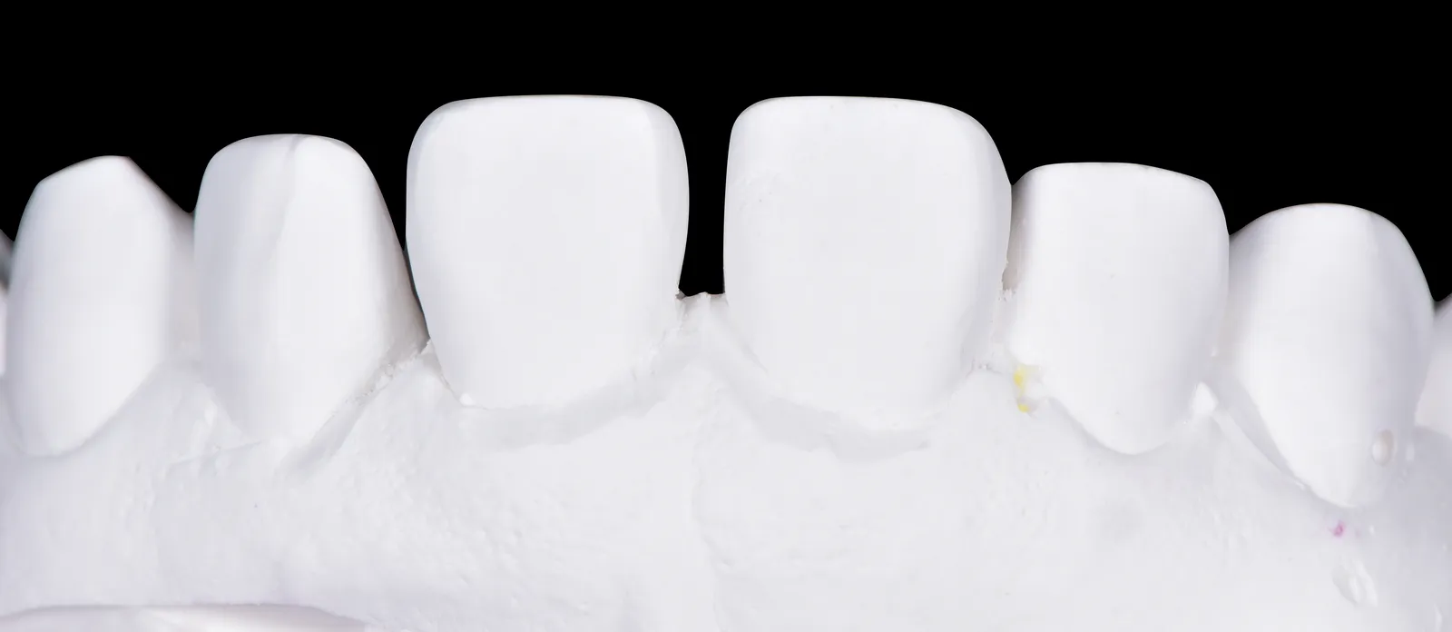 Finished veneers closing a gap between the front teeth, seated on the white master model