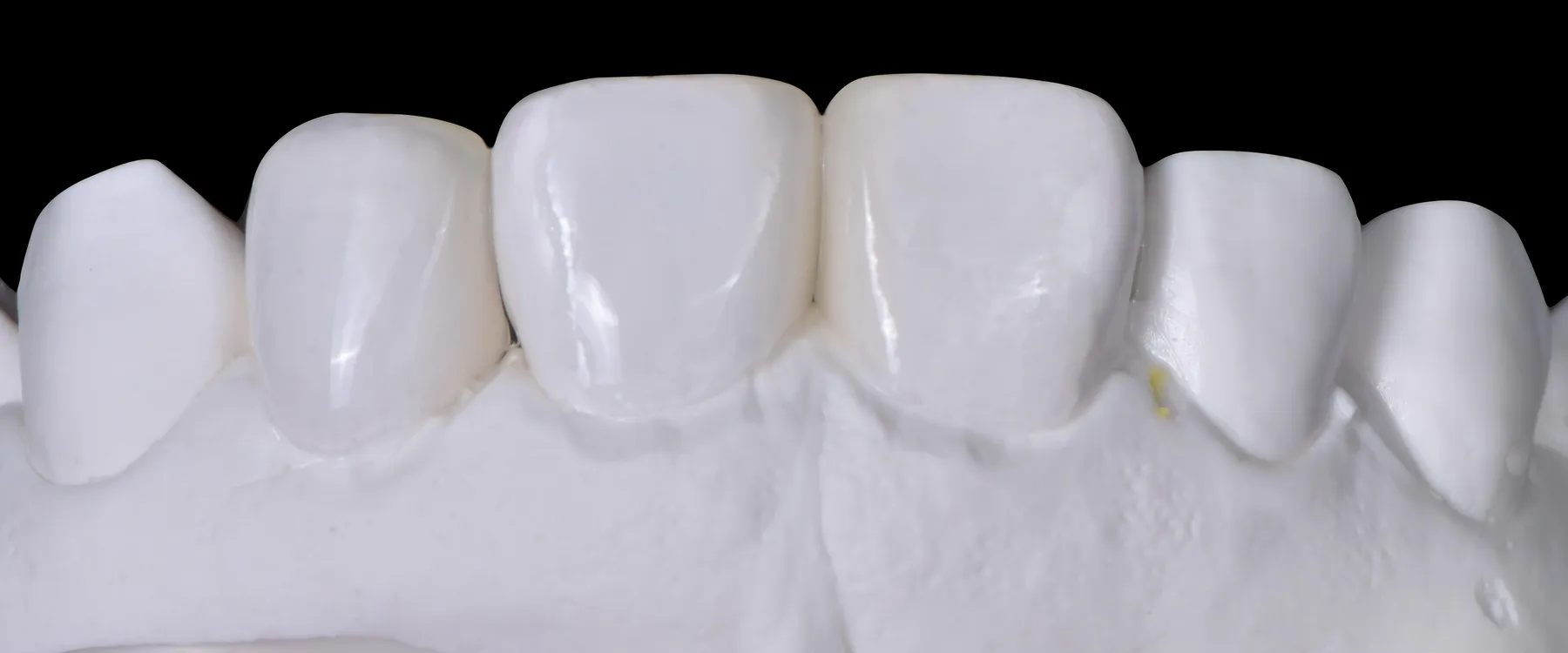 Six finished porcelain veneers seated on the white master model, on a black ground