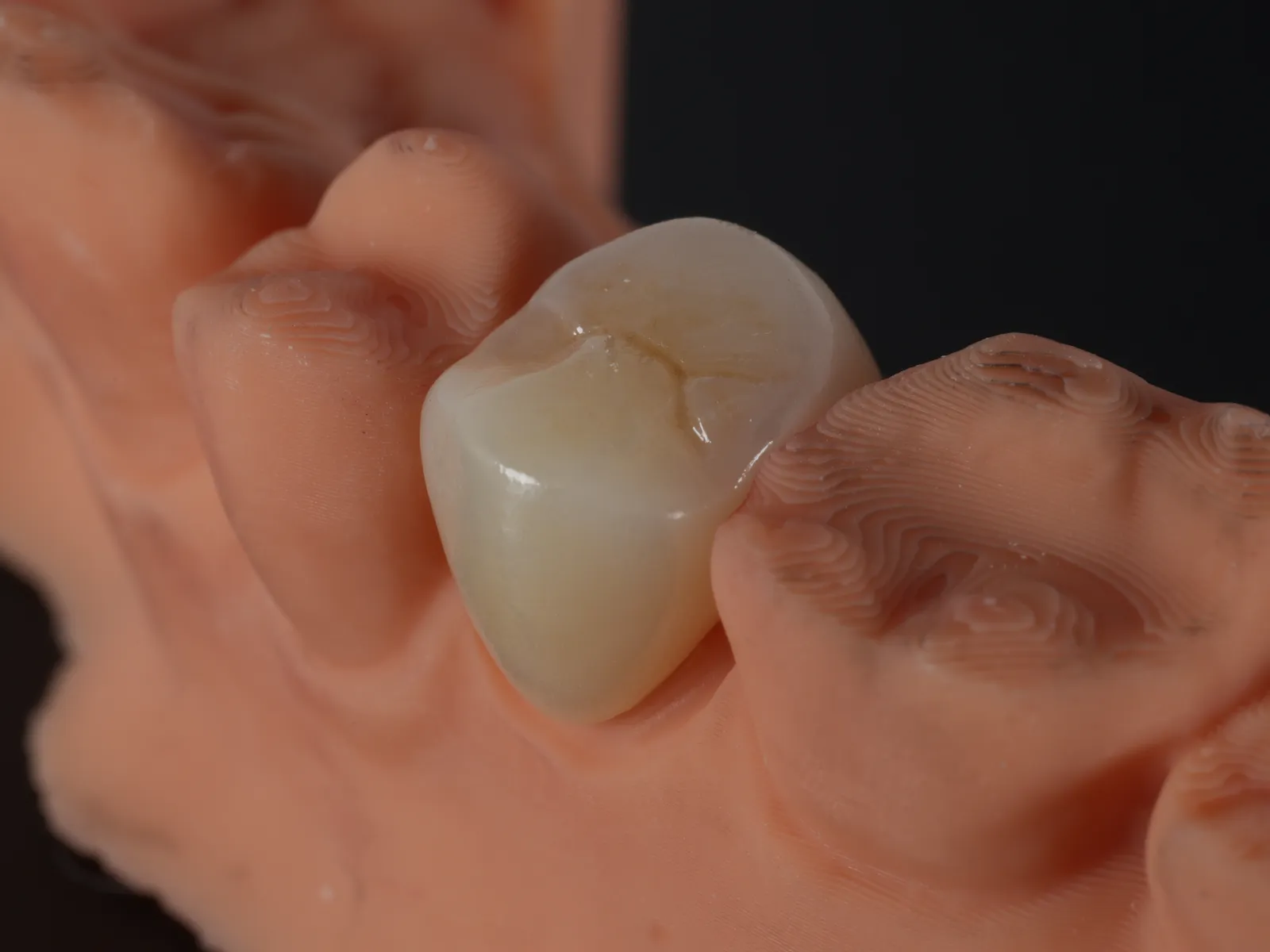 The same crown after stain and glaze, the fissures and the gloss of a natural tooth