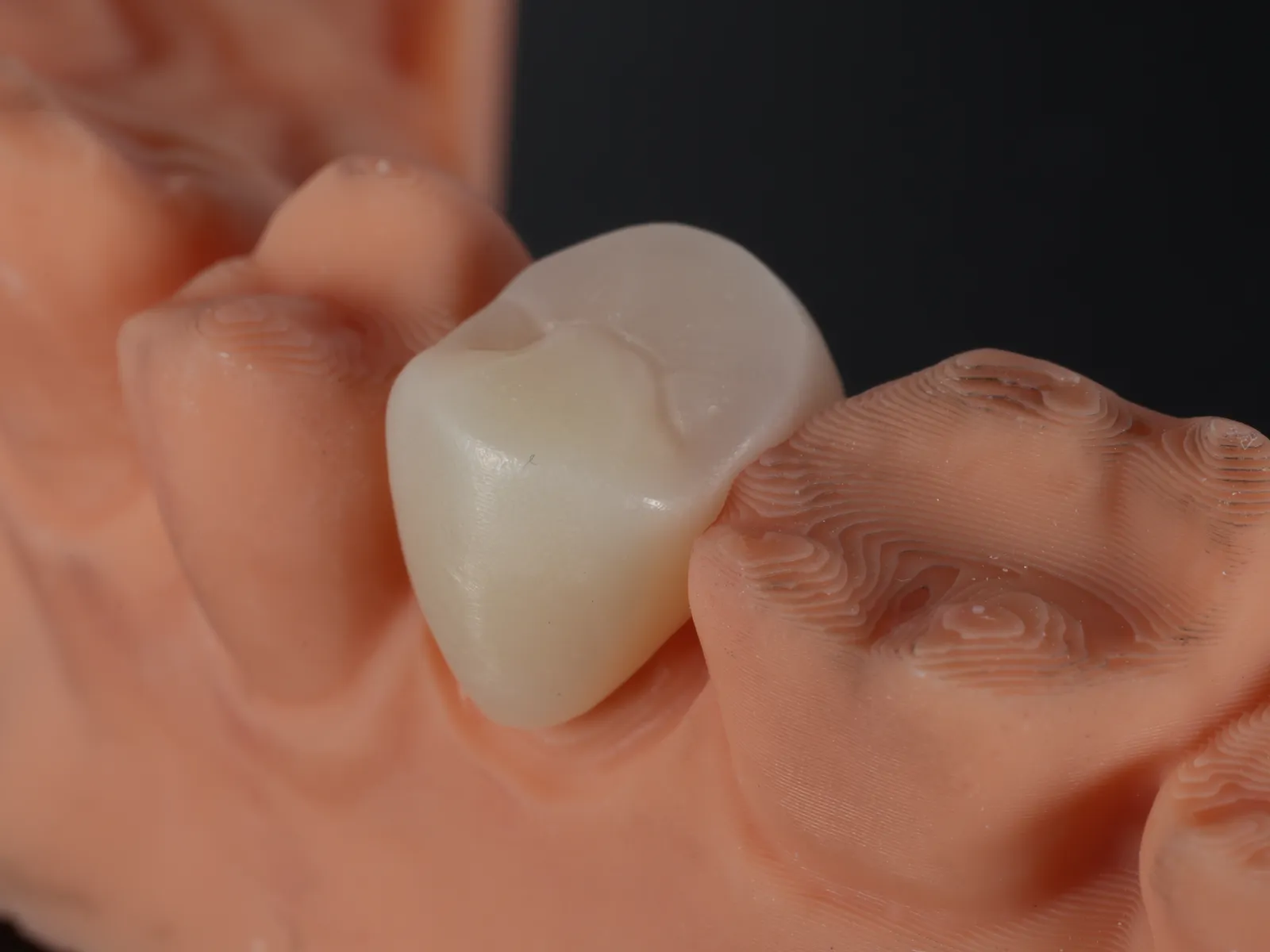 A monolithic zirconia crown on its model straight off the mill, matte and uniform