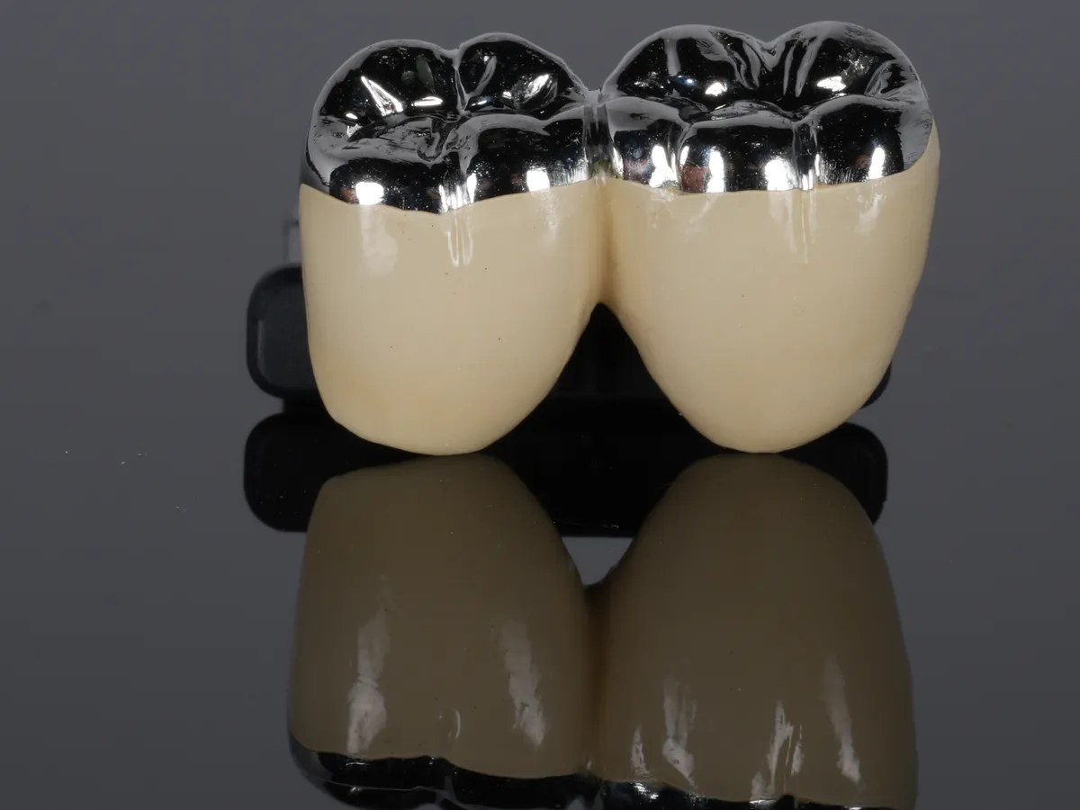 A porcelain-fused-to-metal bridge, the metal biting surfaces showing