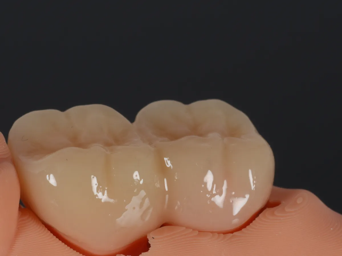 A milled PMMA provisional seated on its model
