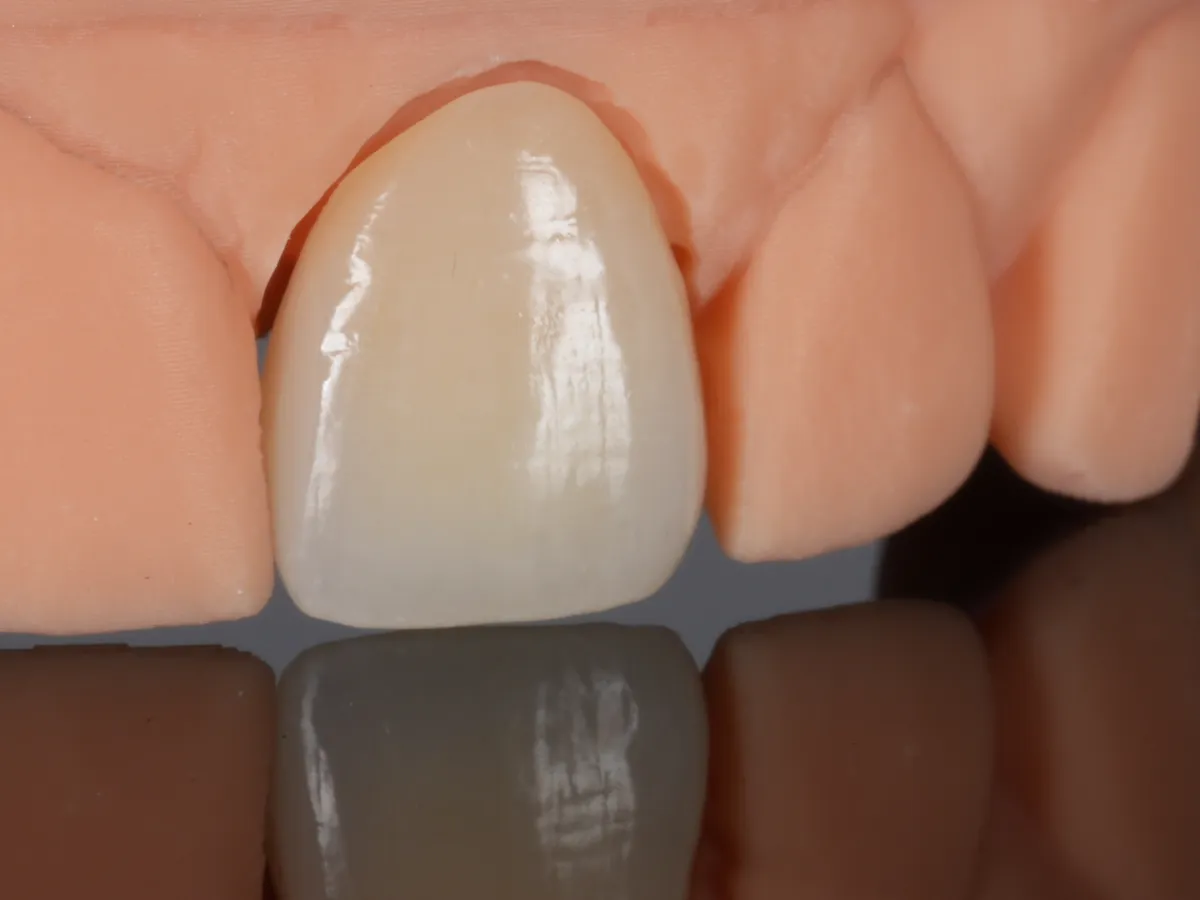 A translucent zirconia crown seated on a front tooth of the model