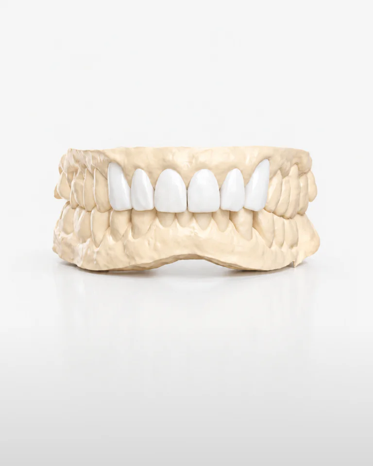 Diagnostic Wax-up