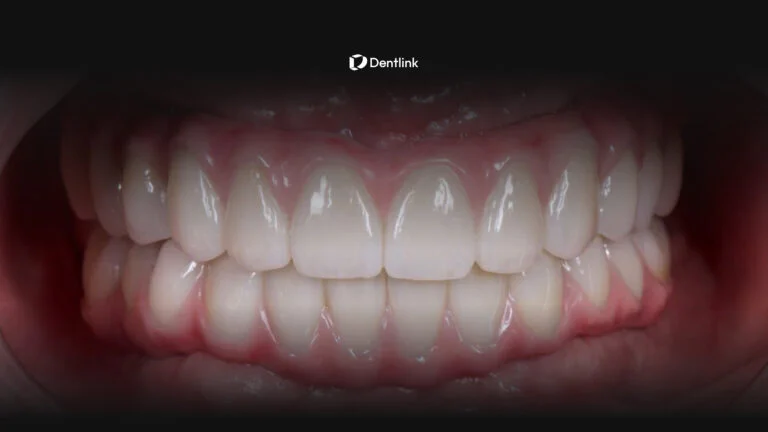 All on X dental lab full arch restoration by Dentlink