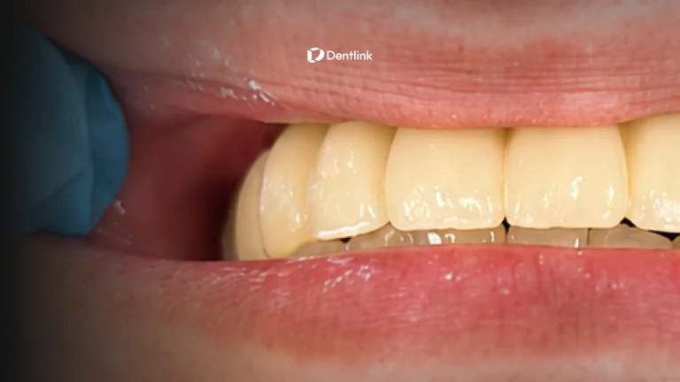 Zero Adjustment Dental Restorations