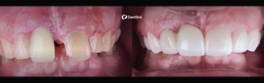 How Predictable Restorations Build Patient Confidence