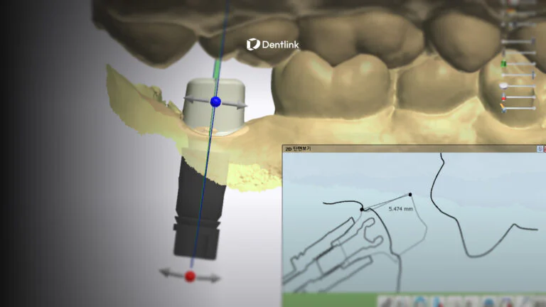 Perfect tissue fit implant restoration by Dentlink