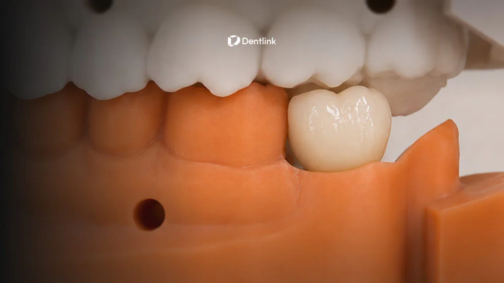 Implant restoration with ideal tissue fit