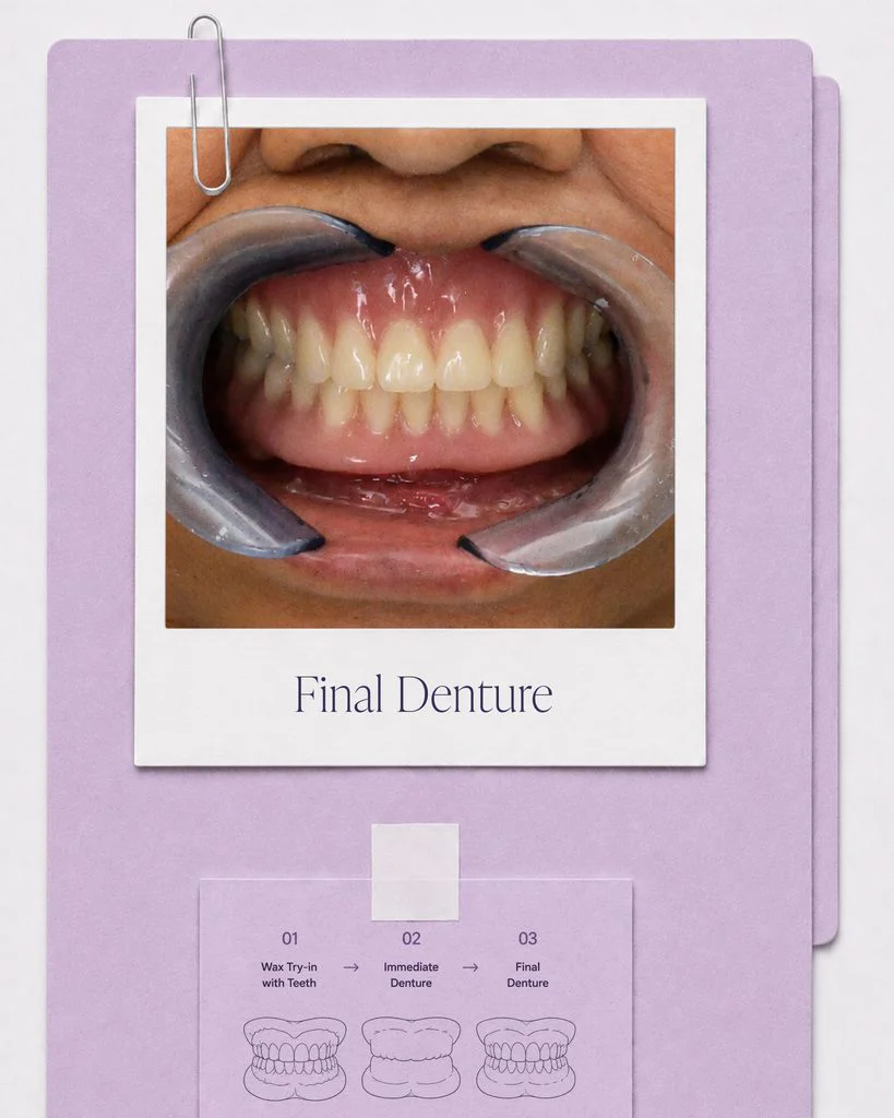 Digital denture workflow from wax try-in to immediate and final denture