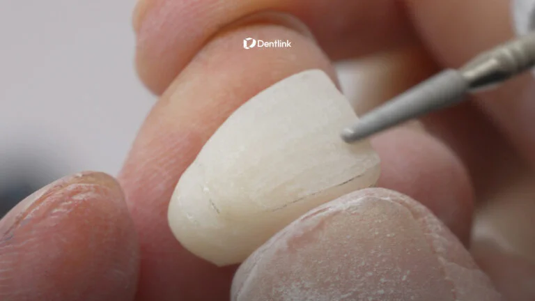 Dental technician finishing an implant restoration by hand