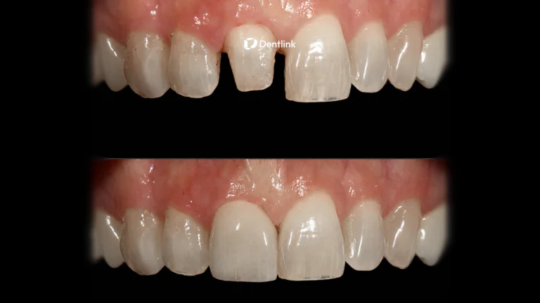 Anterior crown case delivered by Dentlink for Dr. Hyeon Kim