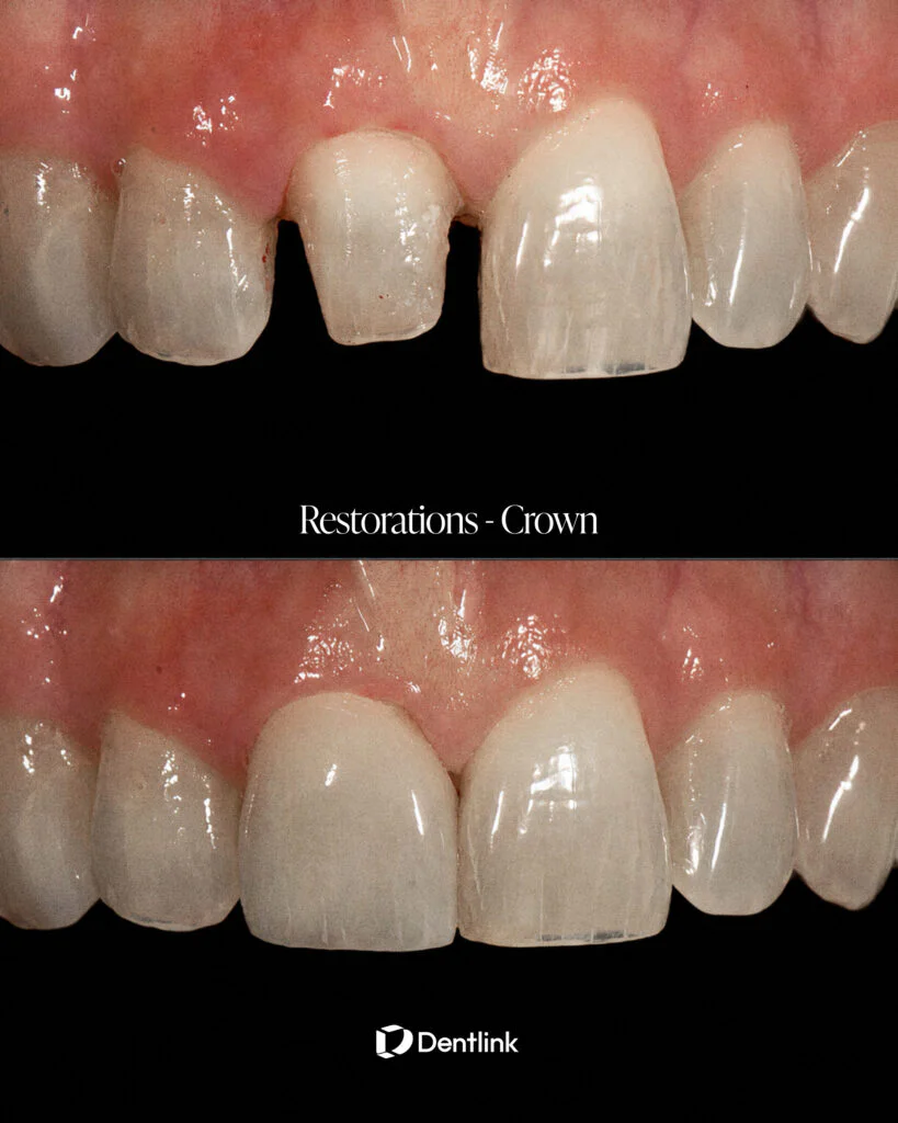 Anterior crown case delivered by Dentlink for Dr. Hyeon Kim