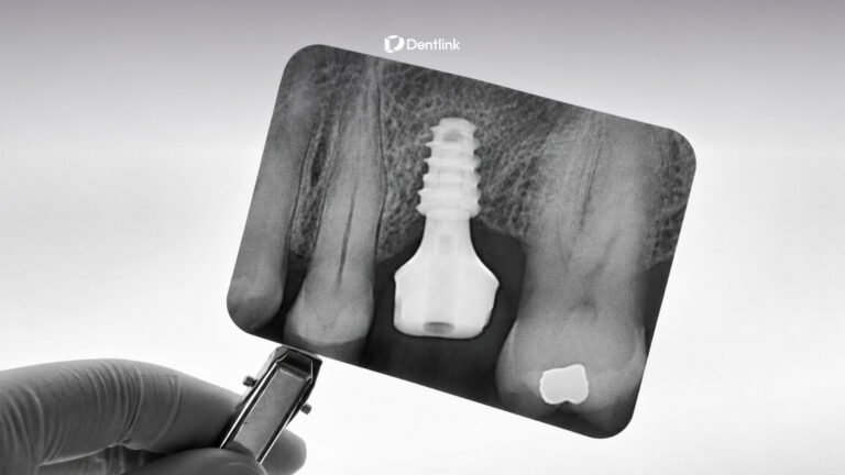Implant restoration cases showing dentist technician communication for predictable SCRP delivery