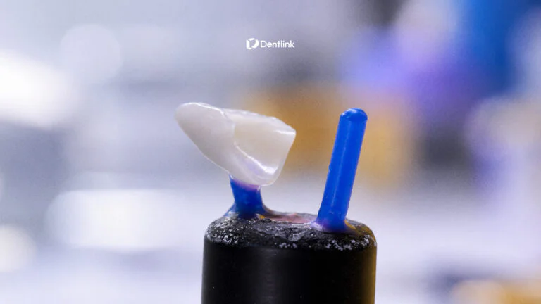 E.max veneers made from lithium disilicate by a dental technician
