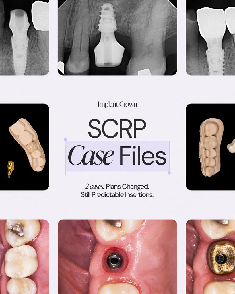 Two different implant restoration treatment paths, both restored with SCRP crowns fabricated by Dentlink.