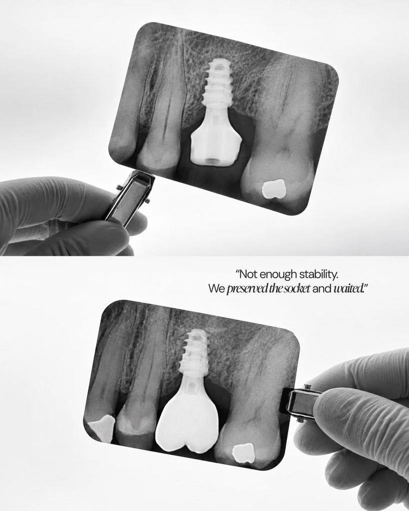 Delayed implant placement after socket preservation before SCRP restoration