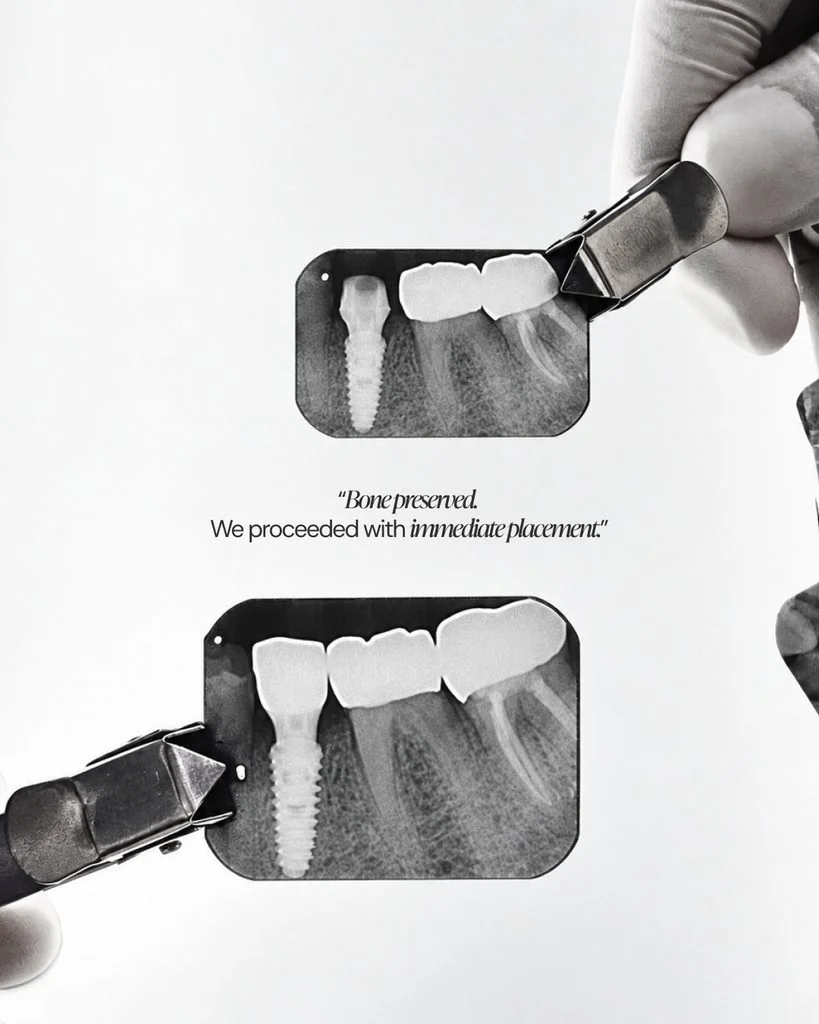Immediate implant placement after bone-preserving extraction before SCRP restoration