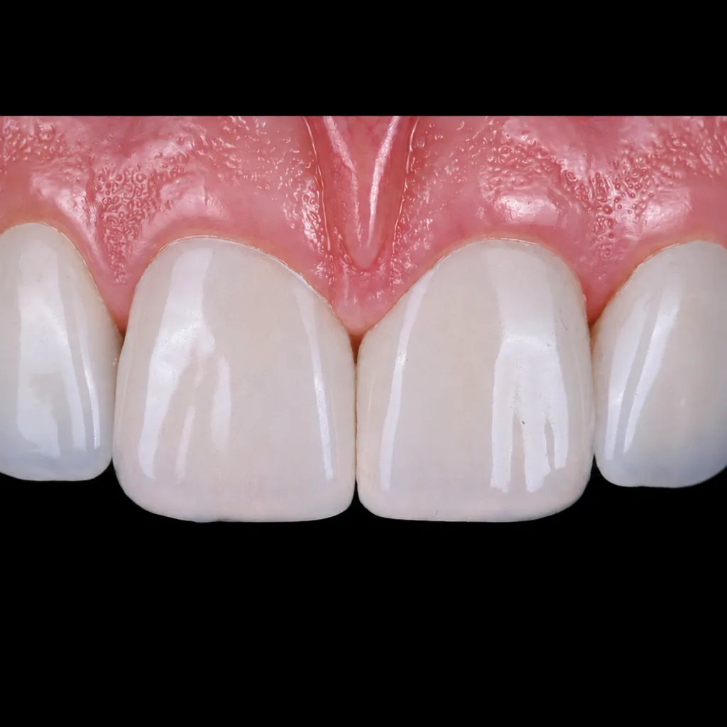 Six pressed lithium disilicate veneers seated, an even shade through every tooth