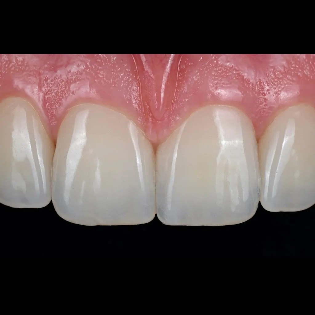 Hand-layered feldspathic veneers among natural teeth, light passing through the edge
