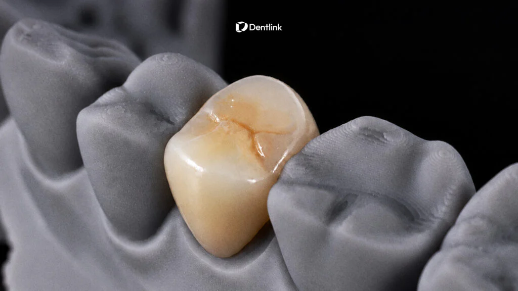 Looking for a Dental Lab for Crowns? Start With What Happens at the Chair