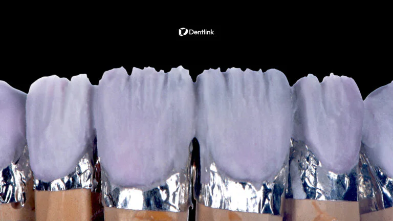 What Makes Porcelain Veneers Look Natural? Inside the Lab
